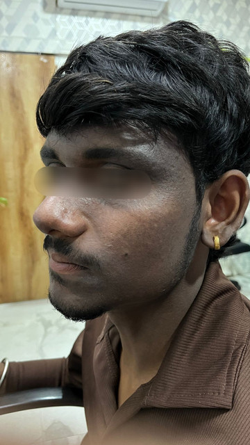 Before acne treatment