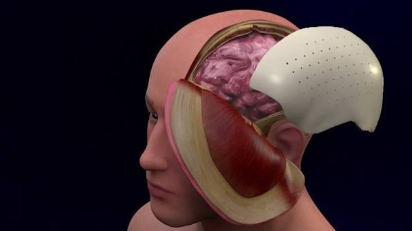 Cranioplasty skull defect repair