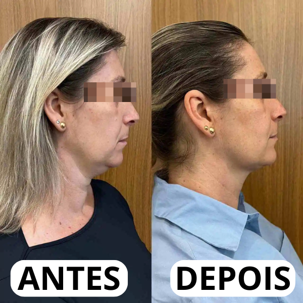 Resultado real antes e depois da papada 5