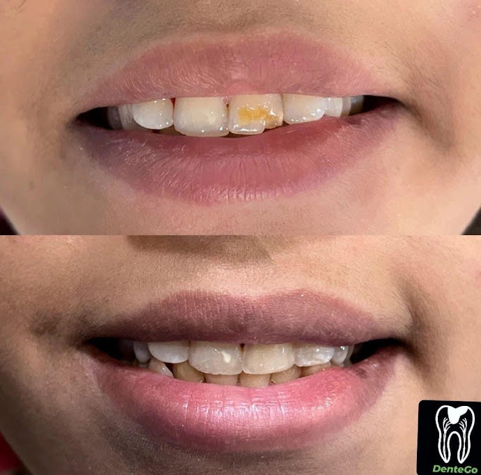 Cosmetic Dental Treatment at DenteGo