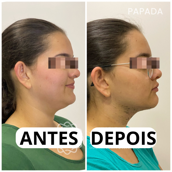 Resultado real antes e depois da papada 2