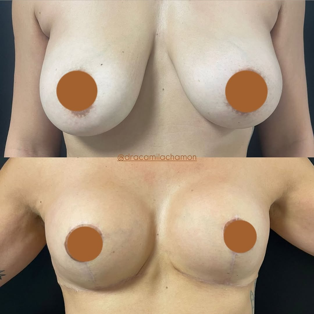 Resultado de lifting facial 1