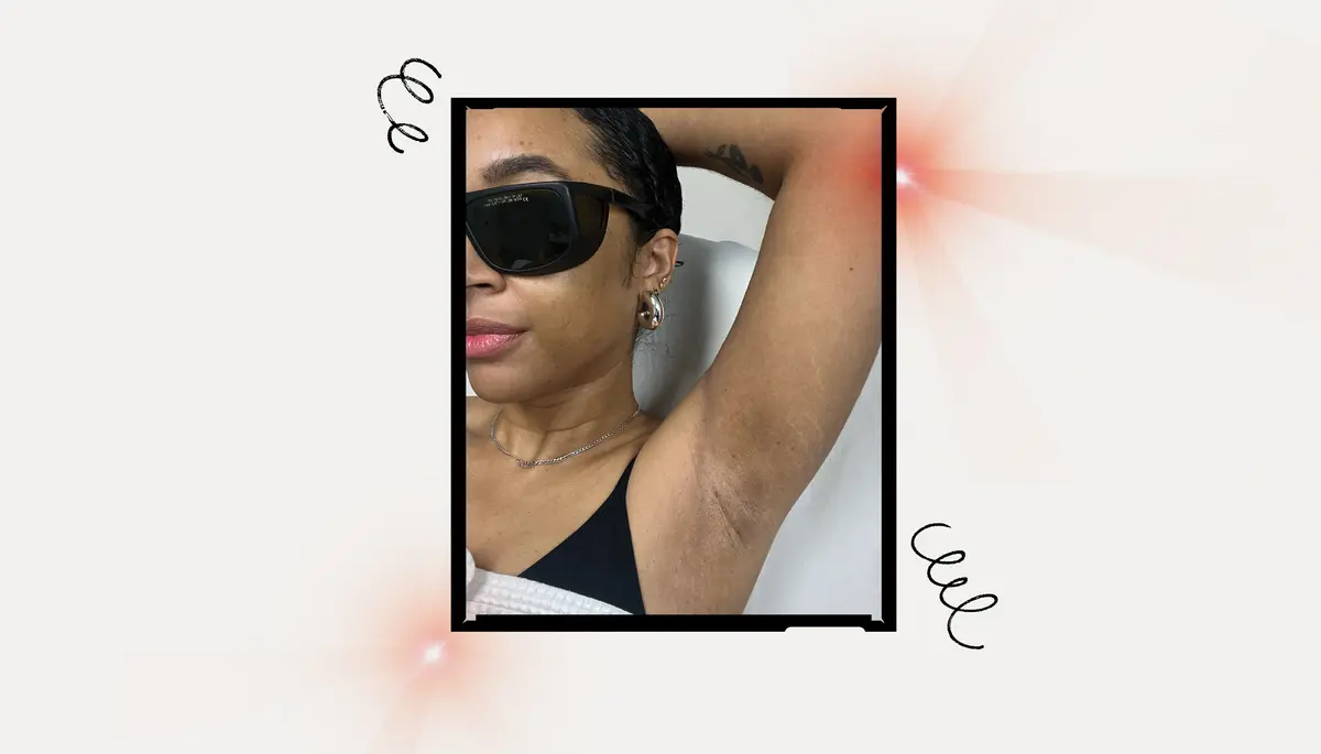 How to Avoid Dark Spots When Using Laser Hair Removal on Darker Skin