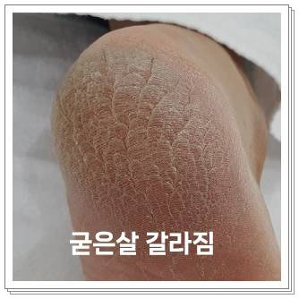 재발 방지를 위한 기본 루틴