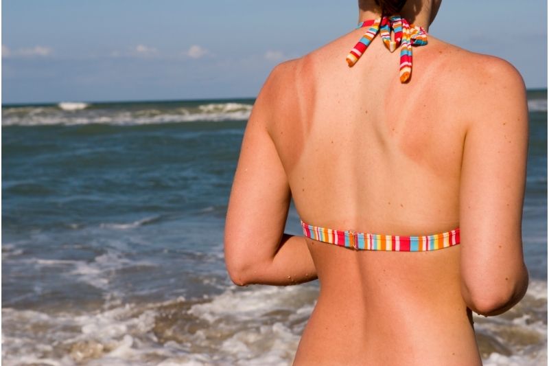 Tanmaxxing, il trend dell’abbronzatura estrema Donna con la schiena bruciata in spiaggia, il trend Tanmaxxing sui social