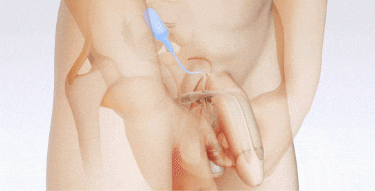 Inflatable Penile Implant