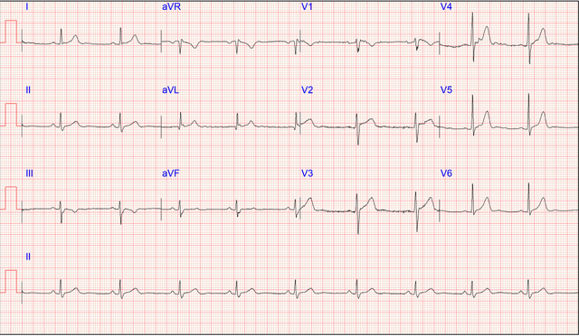 ECG