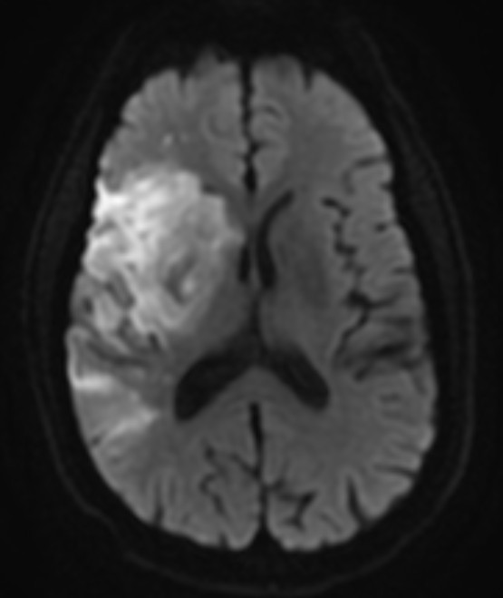 STROKE MRI 4.jpg