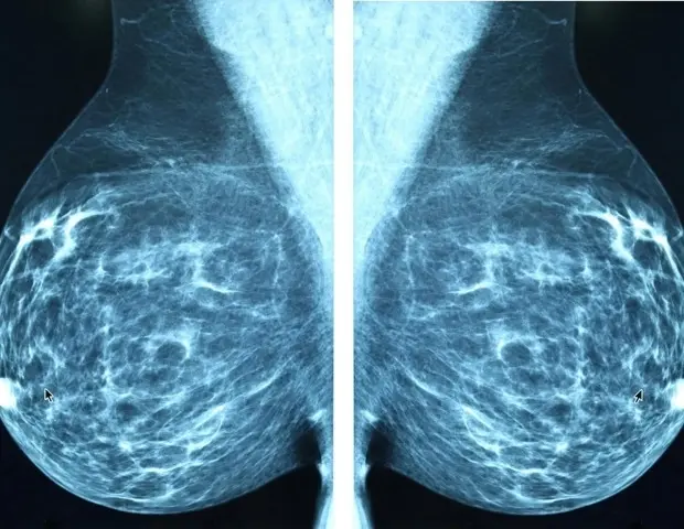 Breast Cancer Cells’ Bone Marrow Hideout Revealed