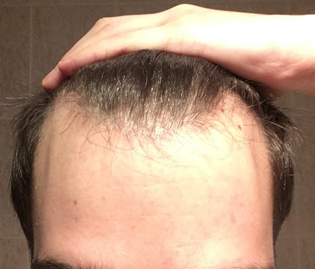 Frontal