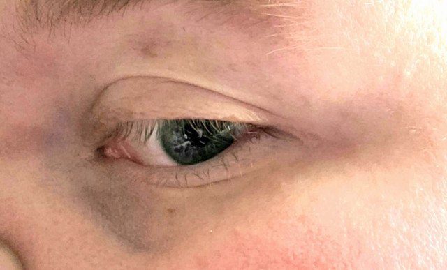 bruised-eye