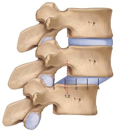 Spondylolisthesis