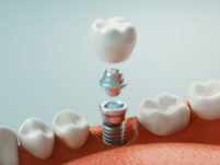 Tooth-Implants-Sydney