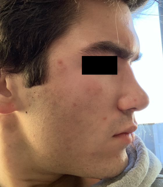 After revision rhinoplasty. Still have a dorsal hump, bulbous tip.