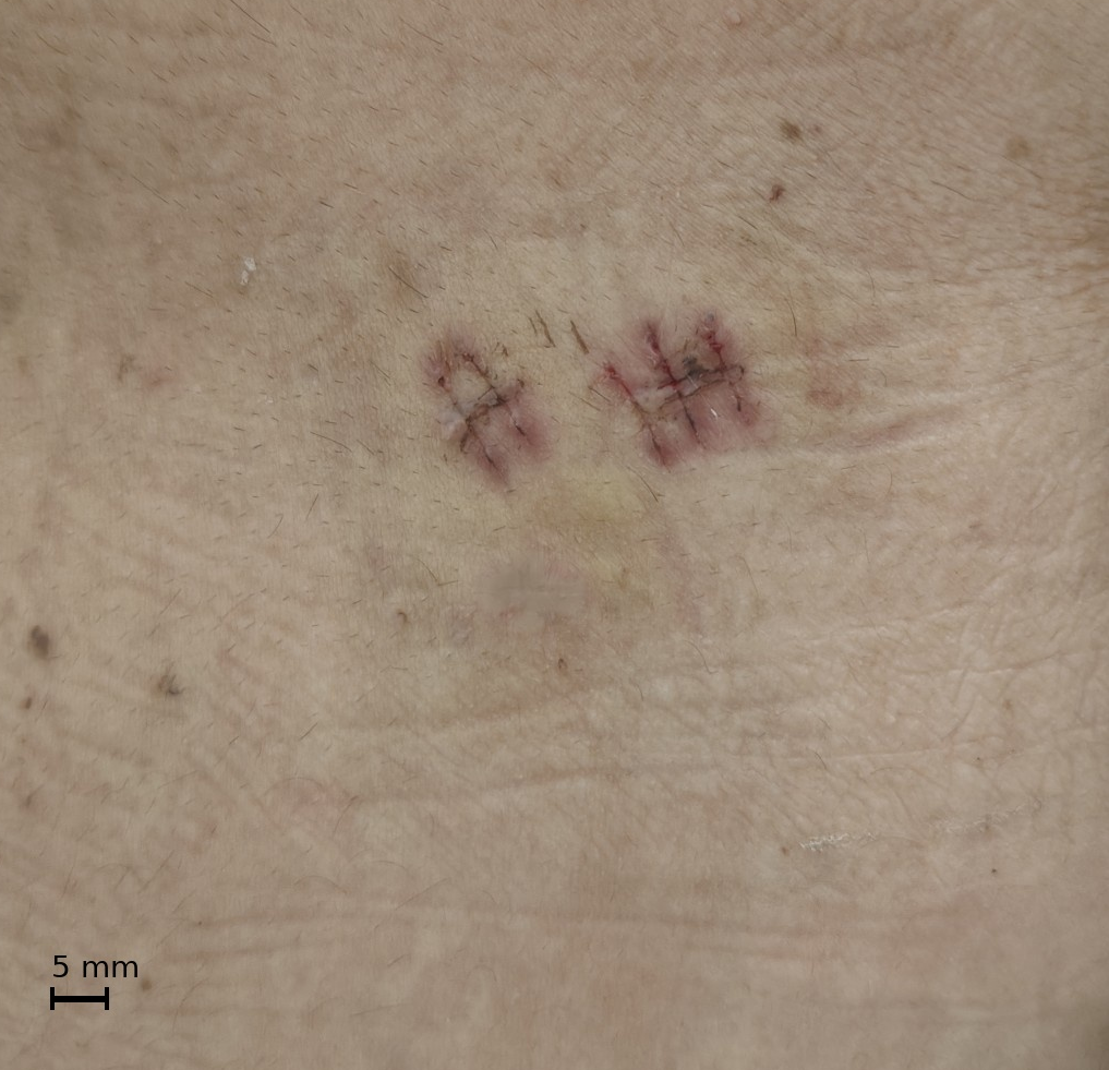 Biportal tiny incisions