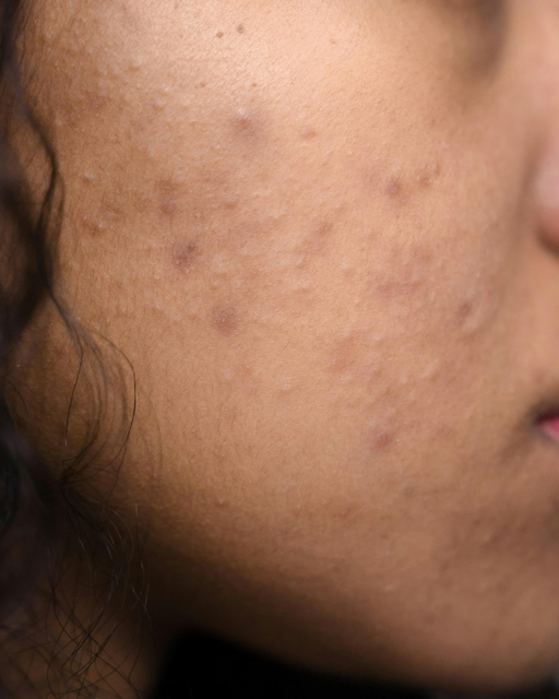 Manchas de Acne
