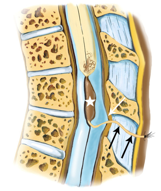 Congenital dermal sinus tract