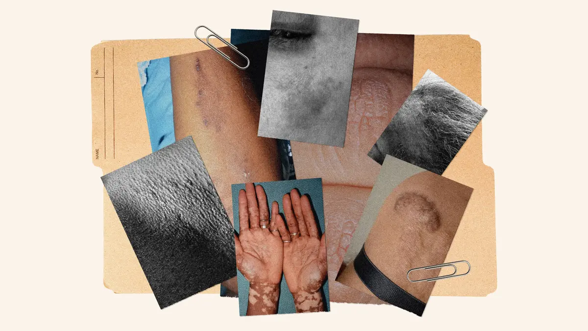Dermatologii: Condiții comune ale pielii pe pielea întunecată: ce vor să știi dermatologii