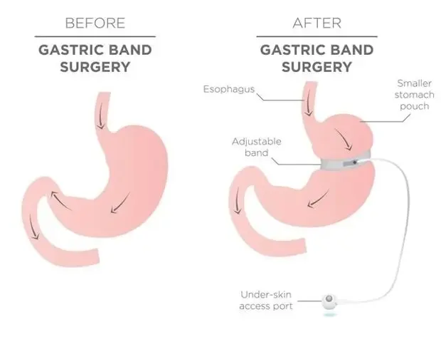 Bariatric Surgery Tied to Increased Alcohol Risk
