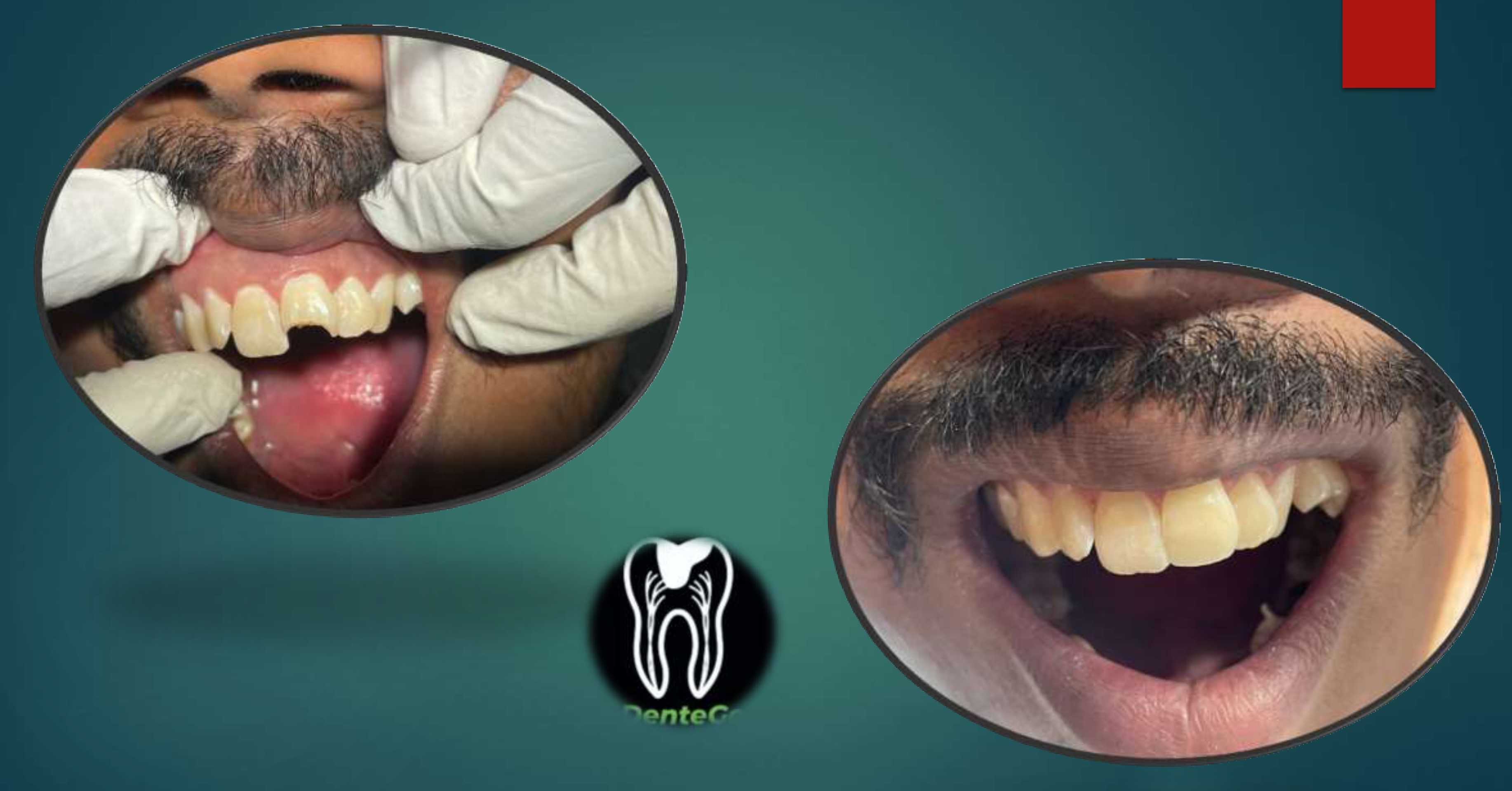 Cracked and Fractured Teeth