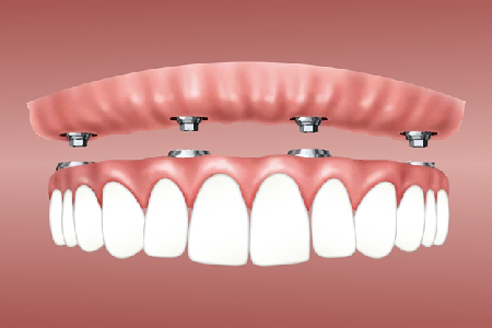 Dental-Implants-Cost
