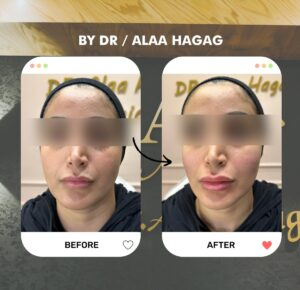 صورة قبل وبعد حقن فيلر الشفاه عند د. علاء حجاج تظهر امتلاء الشفاه وتناسقها