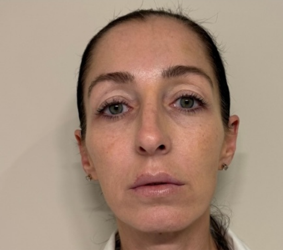 After Sofwave treatment results at Let's Face It Med Spa