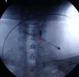 Image 4 - Ganglion Impar