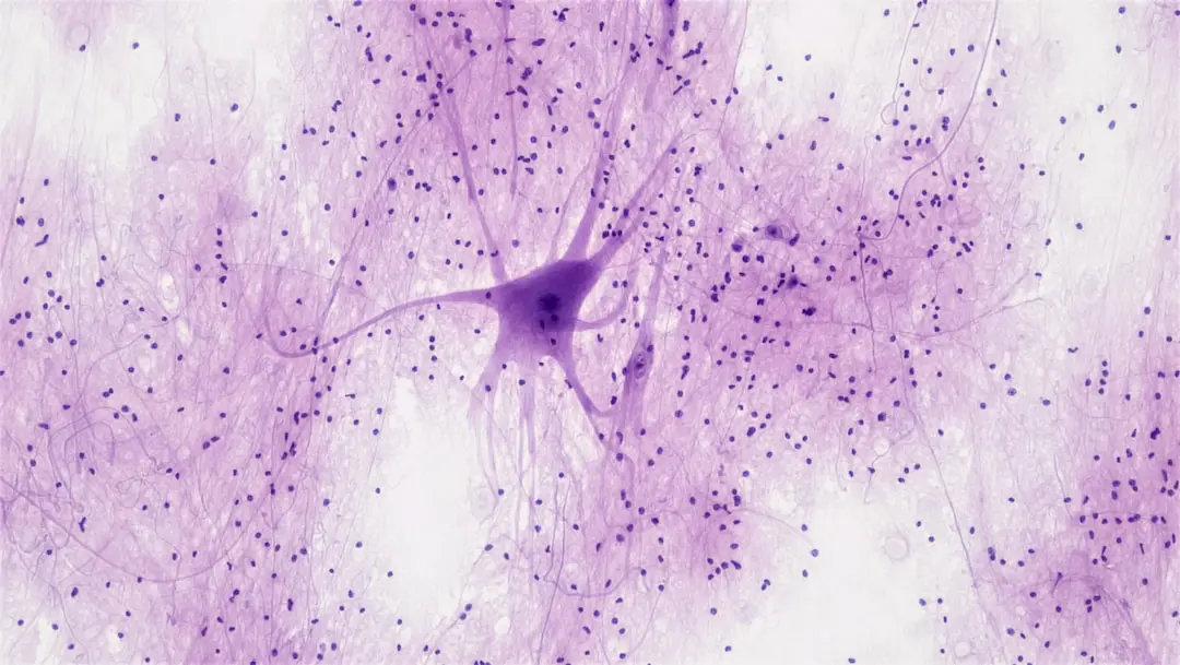 Disrupted Neuronal Microexons Drive Hyperarousal and Insomnia