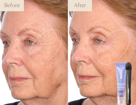 Before and after eye gel result 1