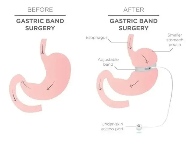 Seniors Find Greater Health Benefits From Surgery Than New Drugs