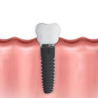 Dental-Implants-Cost