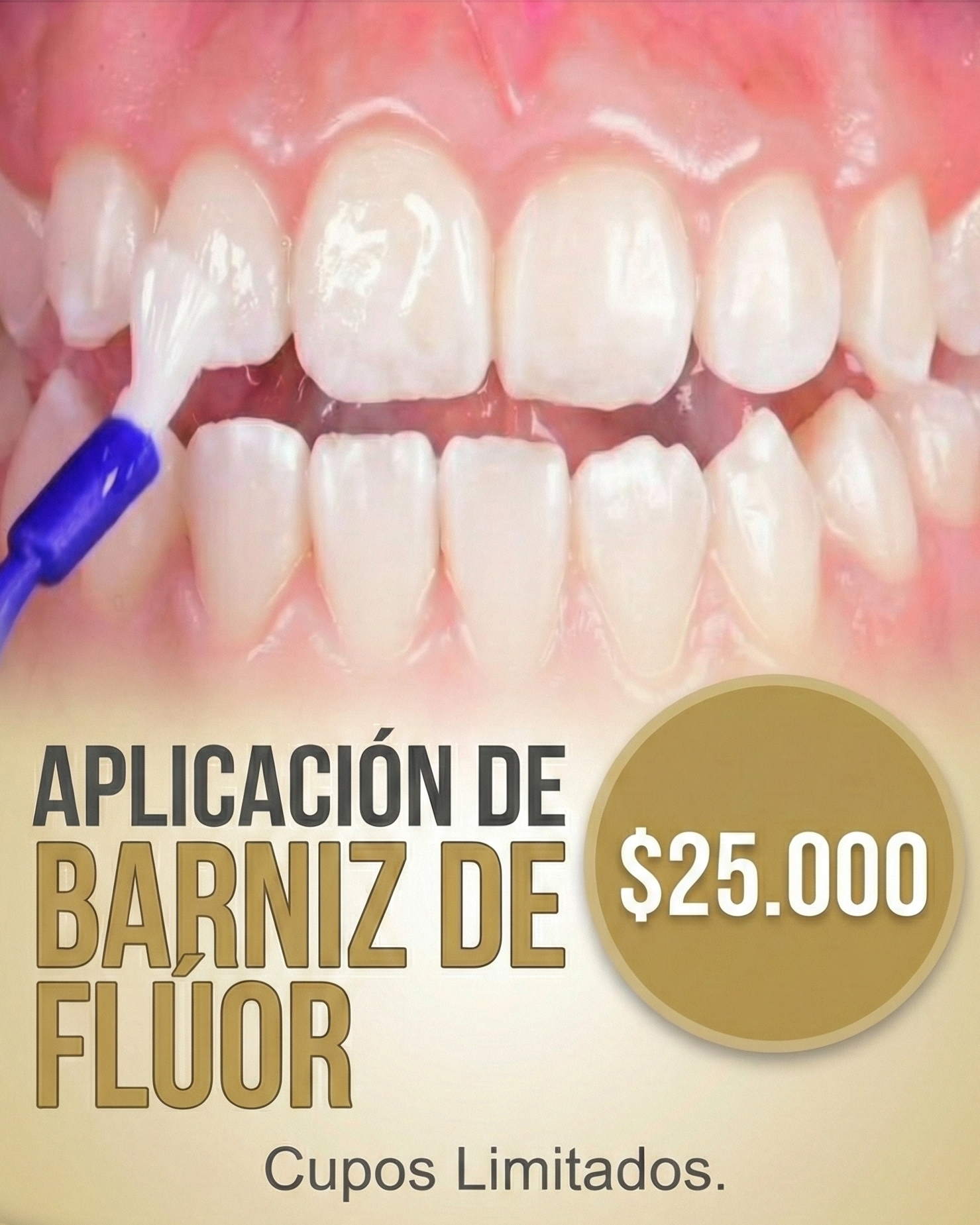 Promoción Aplicación de Flúor