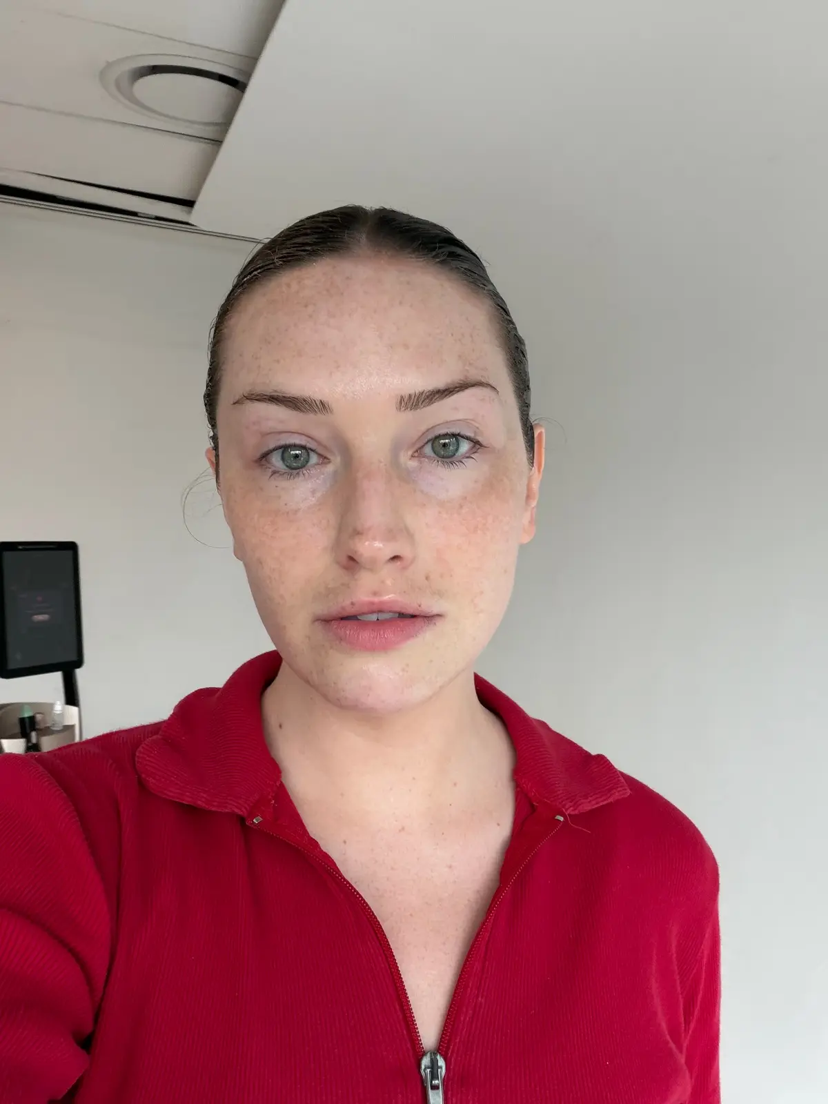 Radiofrequency Therapy Sculpts Jawline and Lifts Face