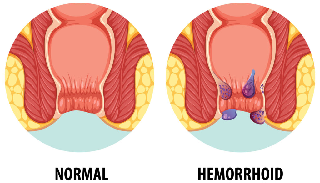 Piles Treatment
