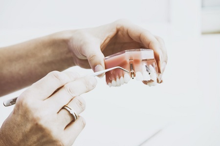Tooth-Implants-Sydney