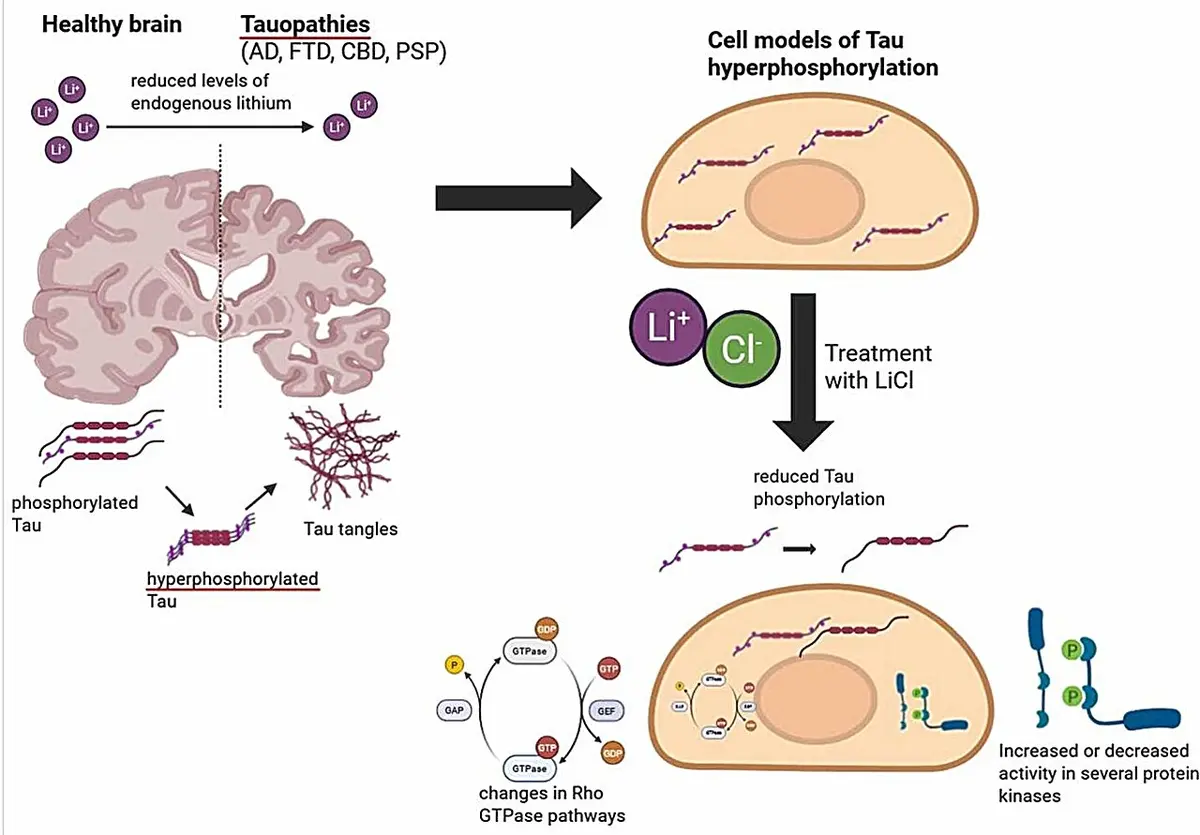 Lithium Reveals New Alzheimer's Clues