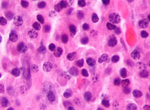Teclistamab Extends Remission in Relapsed Myeloma