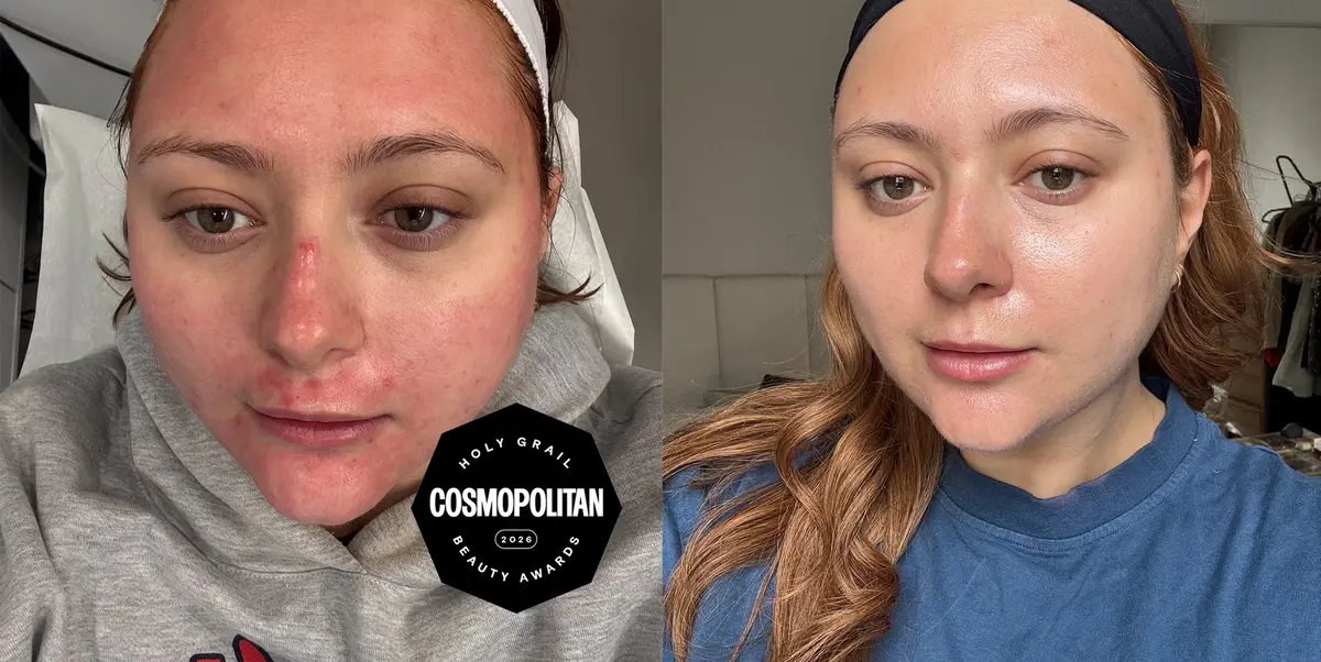 Best Treatment for Acne Scars Revealed