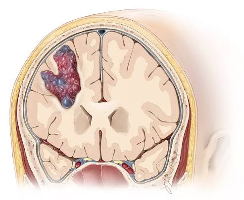 Cavernous malformation MRI