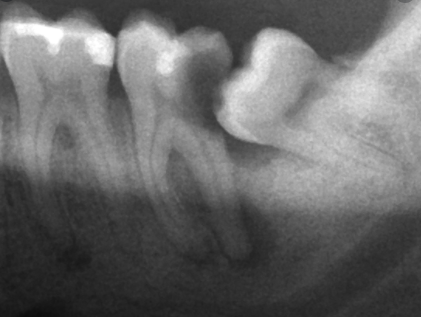 Cheap-wisdom-teeth-removal-Sydney
