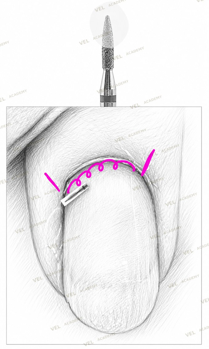 REW step 1 opening cuticle pocket from left sinus to right