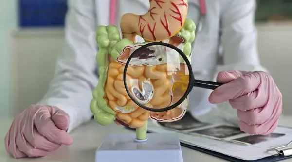 Dieta simplă care reduce cu 87% riscul de deces după cancerul de colon