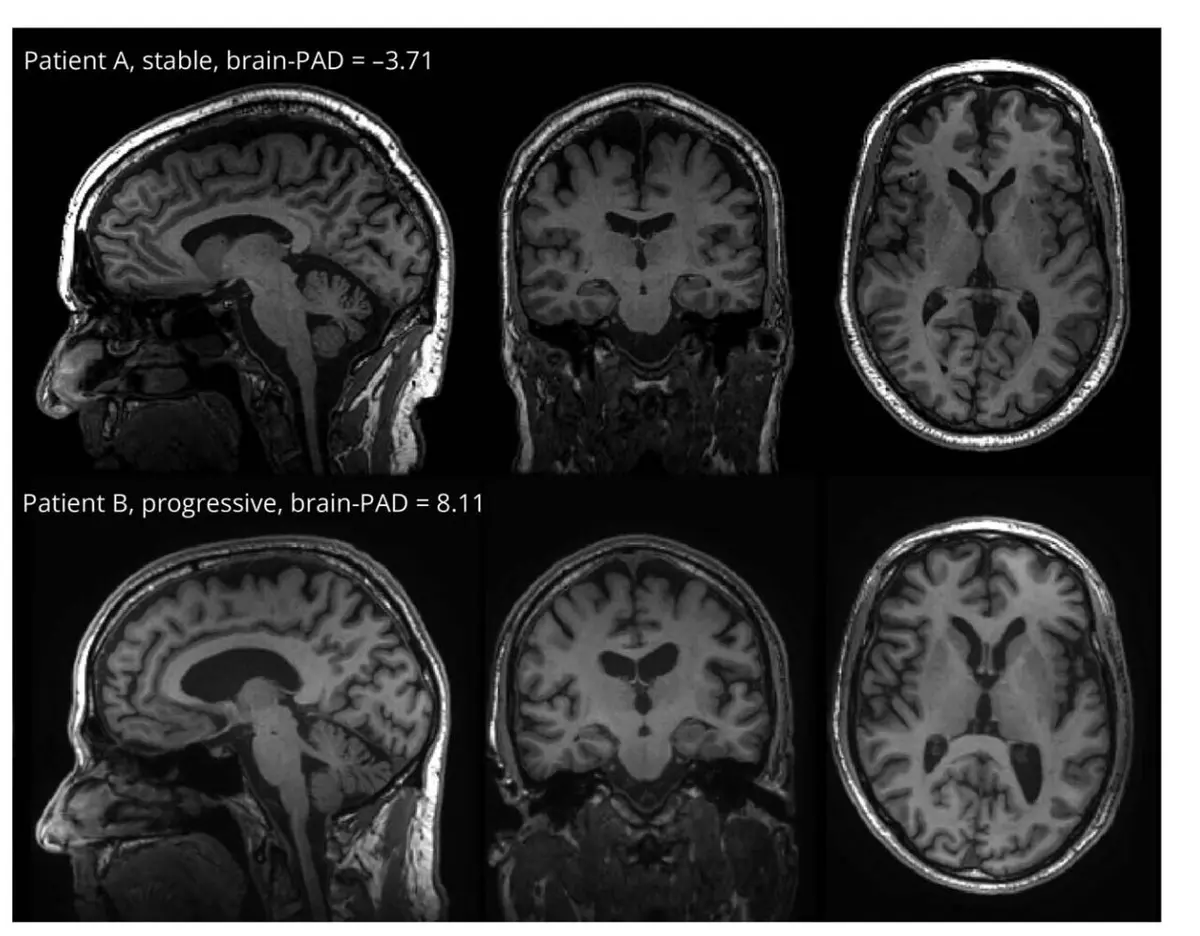AI Brain Age Assessment May Forewarn Dementia Risk Ahead of Traditional Methods