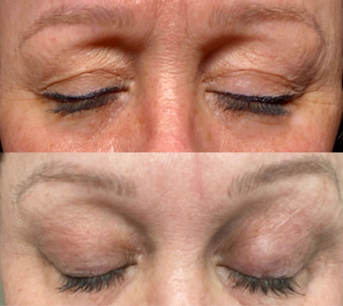 Blefaroplastia Sem Cortes: Quando a Tecnologia Substitui o Bisturi - Imagem 2