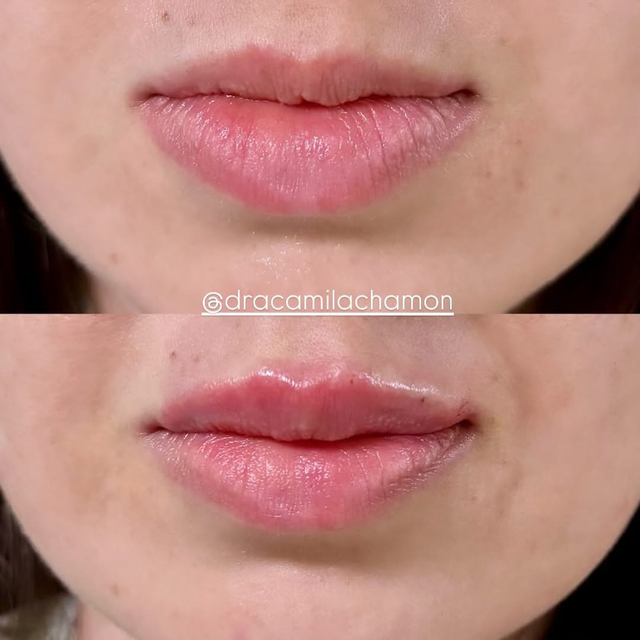 Resultado de lifting facial 2