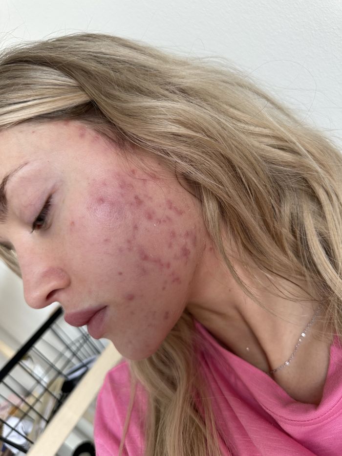 Before: hormonal acne