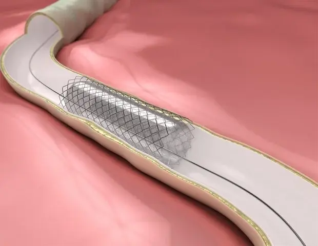 New Stent Design May Aid Gastric Leak Repair