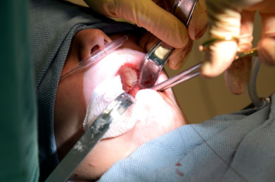 Wisdom-Teeth-Removal-Australia