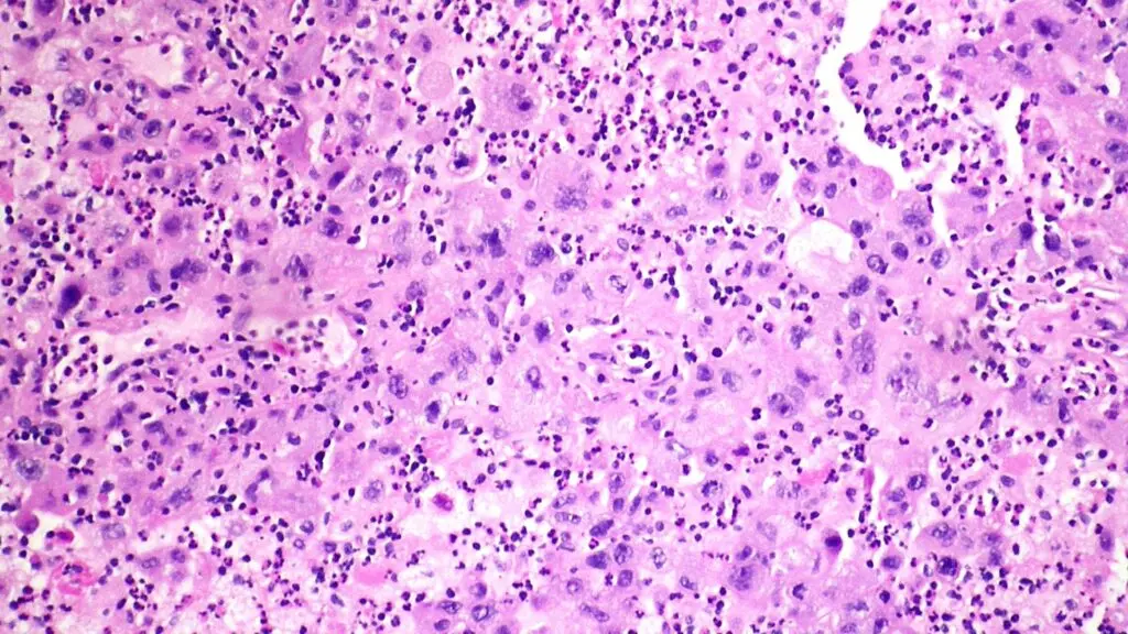 Merck's Lung Cancer Treatment Shows Significant Progress